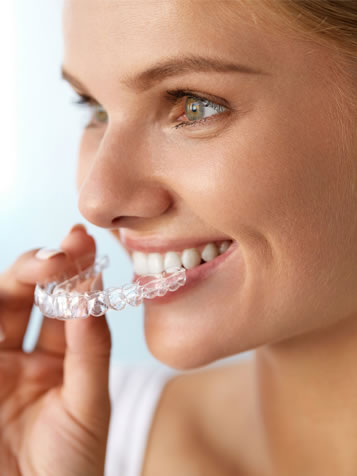 clear aligners