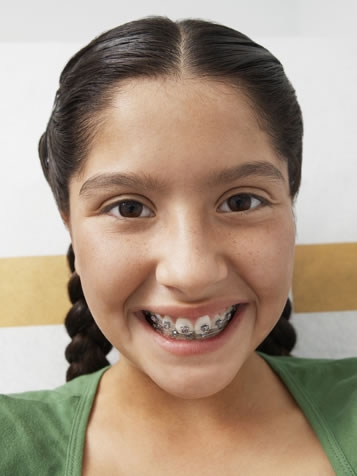 types of braces